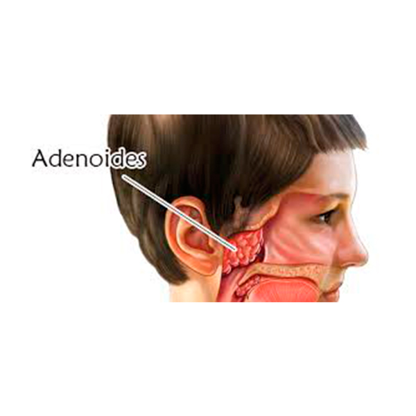 adenoides.jpg